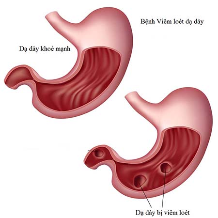 Nguyên nhân gây viêm dạ dày và cách phòng bệnh